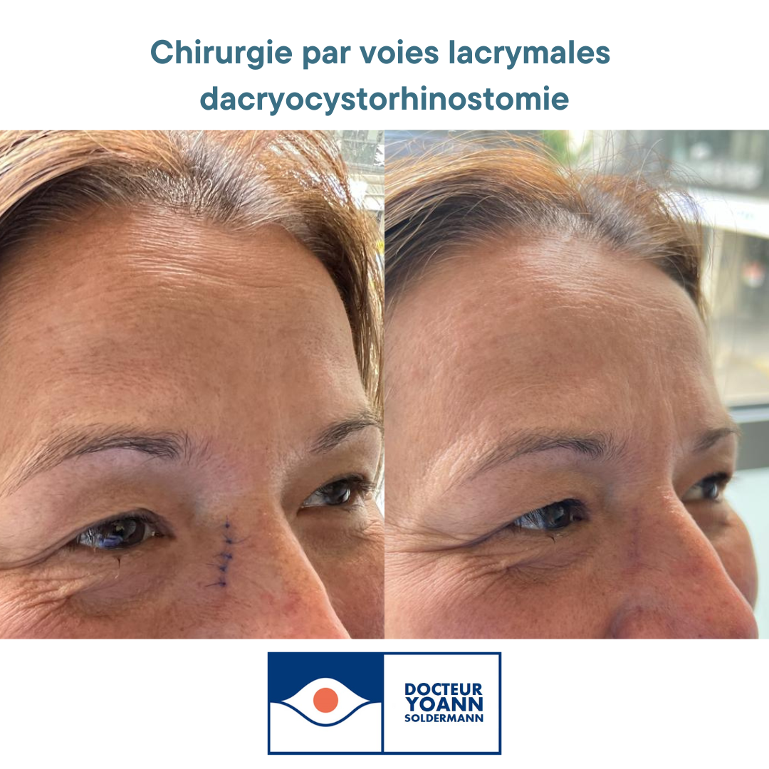 La chirurgie par voies lacrymales : la dacryocystorhinostomie - Chirurgie  Paupière