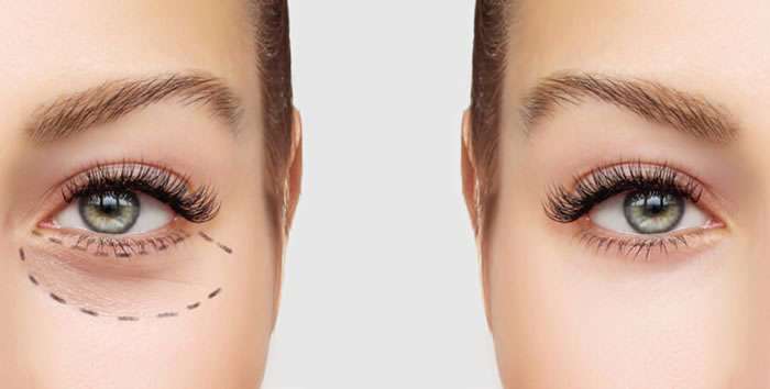 blepharoplastie