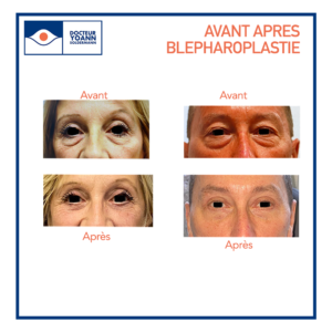 Faire disparaître les poches sous les yeux : c’est possible
