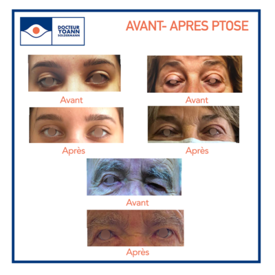 avant après ptose lyon