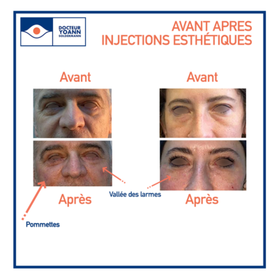 avant après acide hyaluronique regard lyon