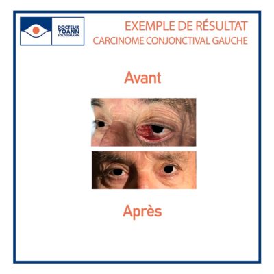 avant après traitement d'un carcinome conjonctival