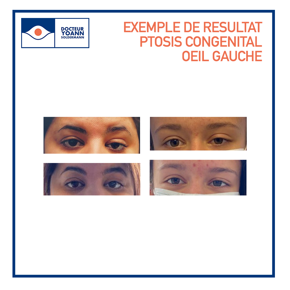 prise-en-charge-du-ptosis-lyon-chirurgie-paupi-re