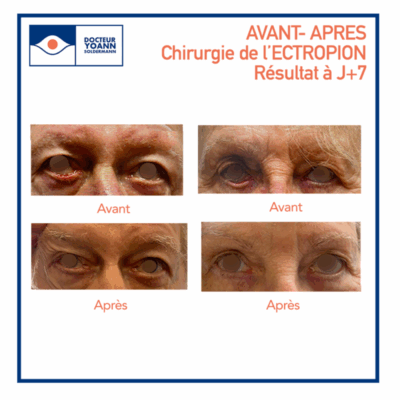 Entropion et ectropion à Lyon – malpositions des paupières
