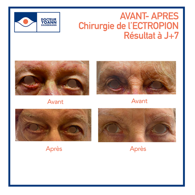 Entropion et ectropion à Lyon – malpositions des paupières