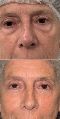 Chirurgie des poches sous les yeux à Lyon par blépharoplastie inférieure